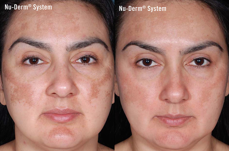 nuderm before and after photo by advanced medical spa laser center in flemington nj