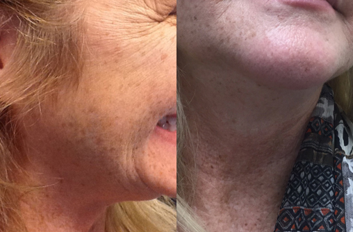kybella before and after photo by advanced medical spa laser center in flemington nj