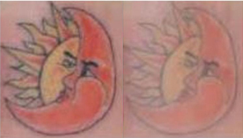 laser tattoo removal before and after photo by advanced medical spa laser center in flemington nj