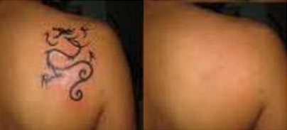 laser tattoo removal before and after photo by advanced medical spa laser center in flemington nj
