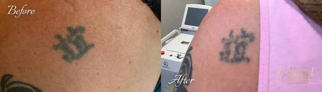 laser tattoo removal before and after photo by advanced medical spa laser center in flemington nj