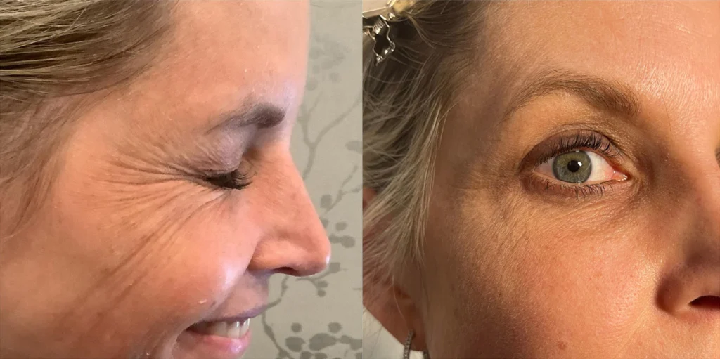 radio frequency before and after photo by advanced medical spa laser center in flemington nj