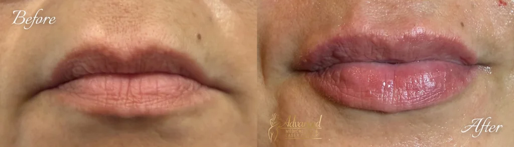 lip fillers before and after photo by advanced medical spa laser center in flemington nj