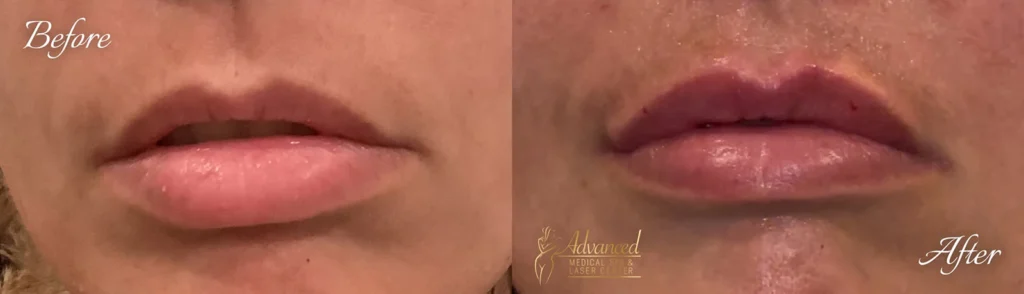 lip fillers before and after photo by advanced medical spa laser center in flemington nj