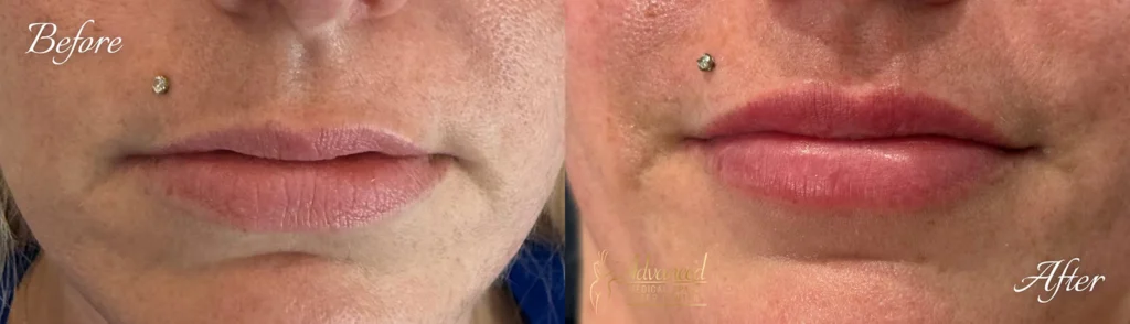 lip fillers before and after photo by advanced medical spa laser center in flemington nj