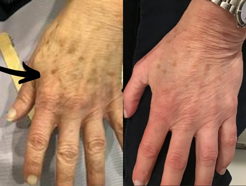 lase resurfacing before and after photo by advanced medical spa laser center in flemington nj