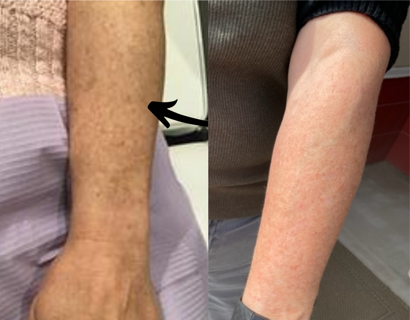 lase resurfacing before and after photo by advanced medical spa laser center in flemington nj