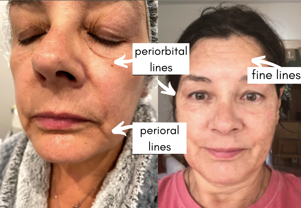 lase resurfacing before and after photo by advanced medical spa laser center in flemington nj