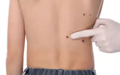 Why Do Skin Tags Form?