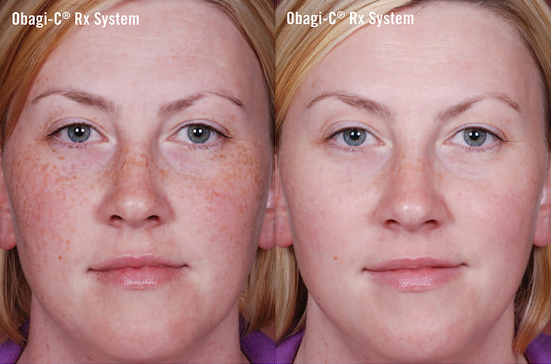 obagi c rx system before and after photo by advanced medical spa laser center in flemington nj