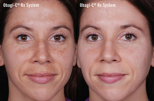 obagi c rx system before and after photo by advanced medical spa laser center in flemington nj