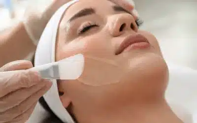 Eliminate Your Acne with a Chemical Peel