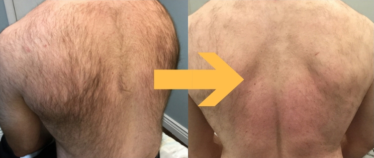 hair removal treatment before and after photo by advanced medical spa laser center in flemington nj