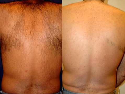 hair removal treatment before and after photo by advanced medical spa laser center in flemington nj