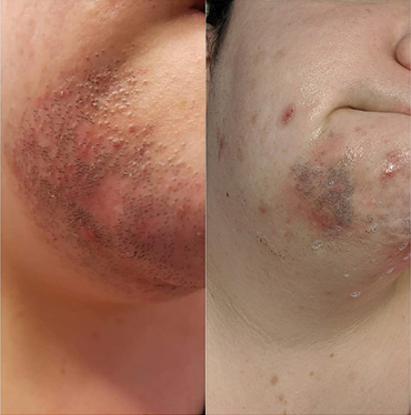 hair removal treatment before and after photo by advanced medical spa laser center in flemington nj