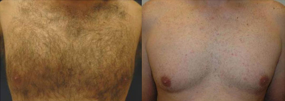 hair removal treatment before and after photo by advanced medical spa laser center in flemington nj