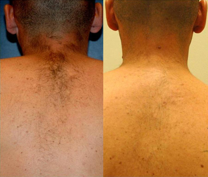 hair removal treatment before and after photo by advanced medical spa laser center in flemington nj