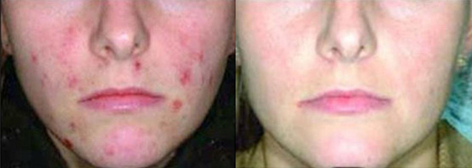 ipl before and after photo by advanced medical spa laser center in flemington nj