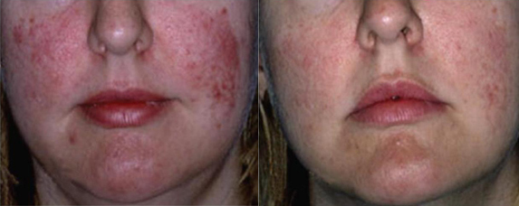 ipl before and after photo by advanced medical spa laser center in flemington nj