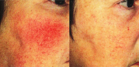 ipl before and after photo by advanced medical spa laser center in flemington nj