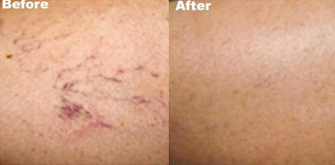 long pulsed yag laser before and after photo by advanced medical spa laser center in flemington nj