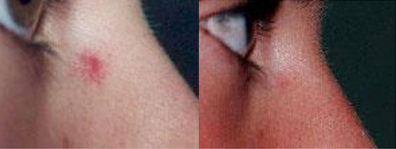 long pulsed yag laser before and after photo by advanced medical spa laser center in flemington nj