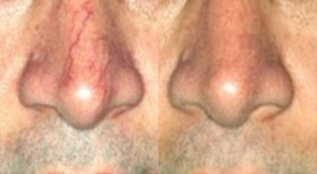 long pulsed yag laser before and after photo by advanced medical spa laser center in flemington nj